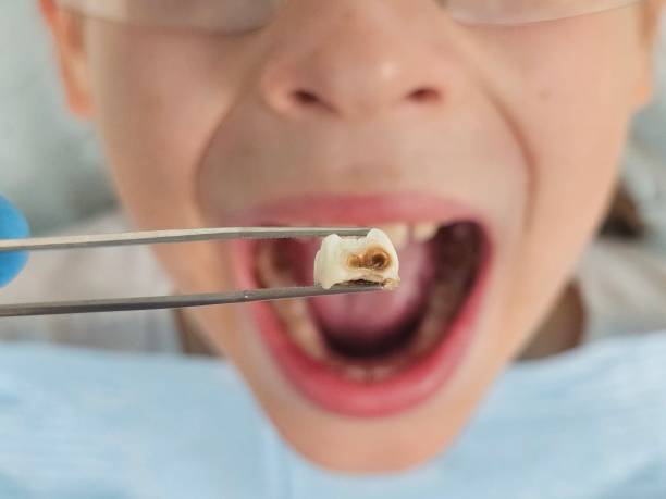 Best Teeth Whitening  in Knox, IN